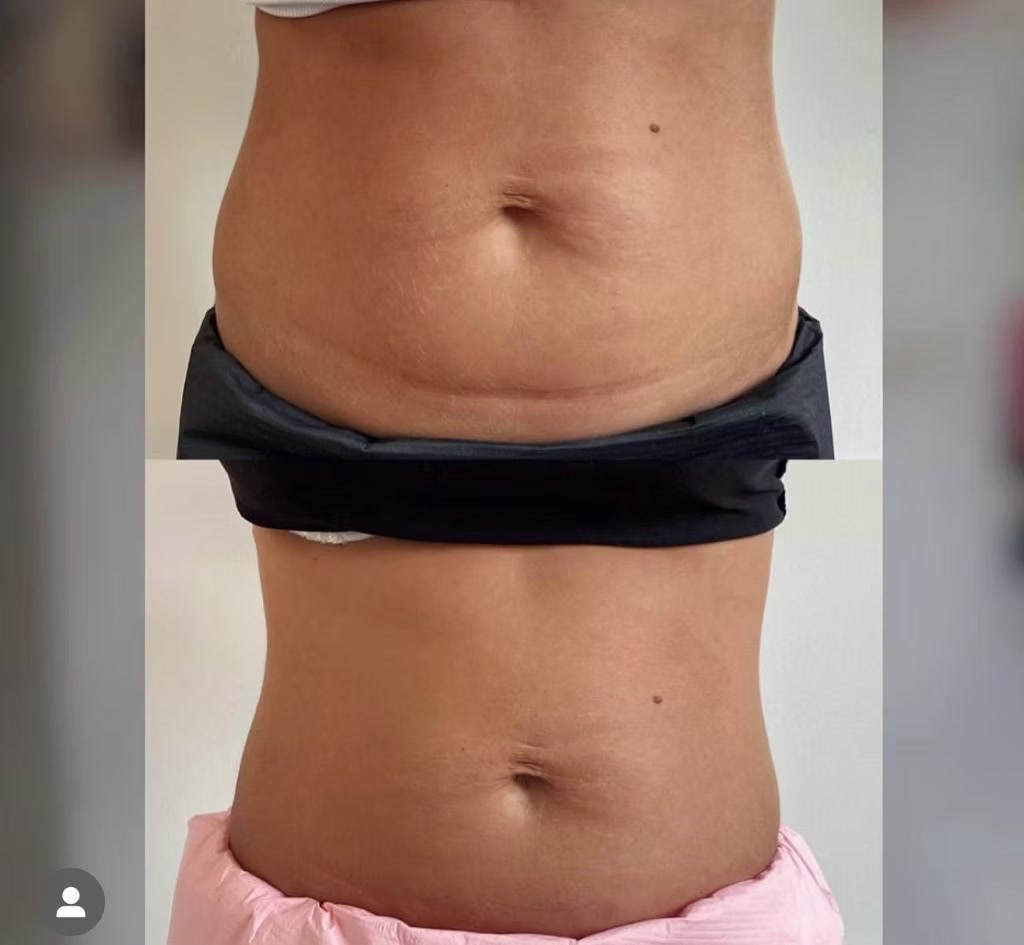 Modelowanie sylwetki po lipolizie